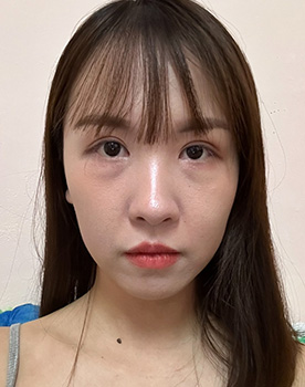 案例2術前